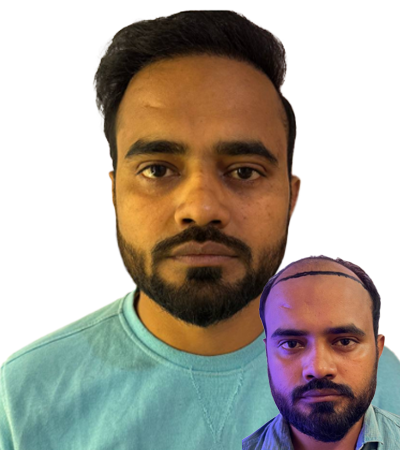 Hairline Transplant Procedure