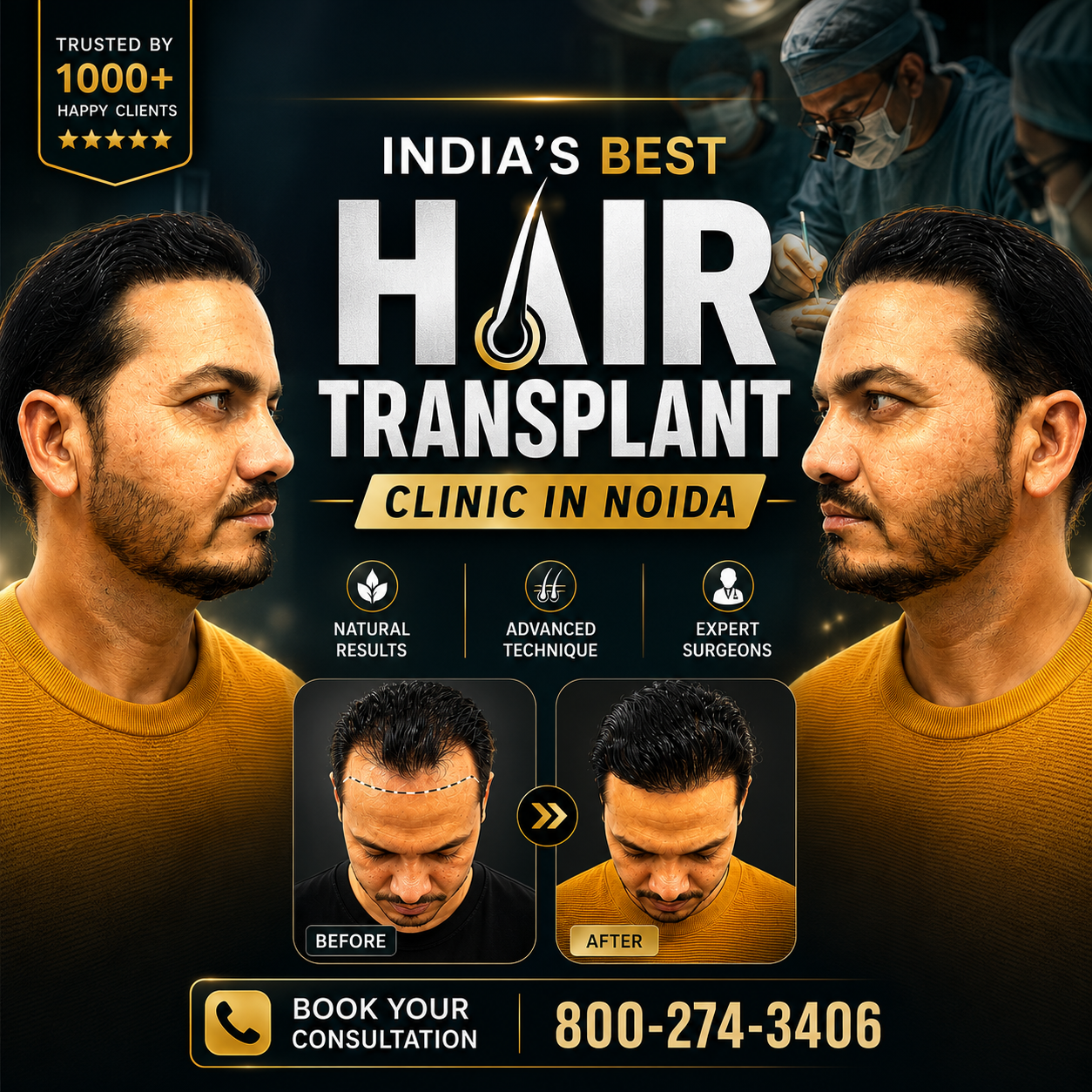 crown density best hair transplant clinic in Noida