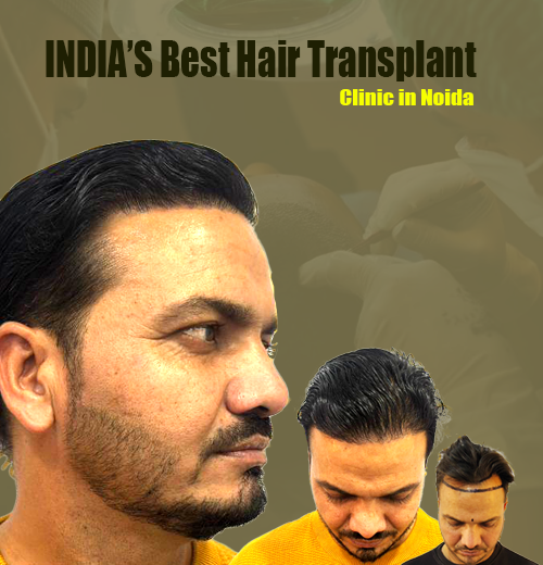 crown density best hair transplant clinic in Noida