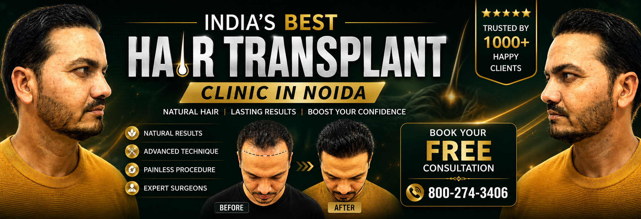 crown density best hair transplant clinic in Noida